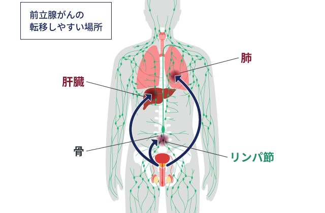 前立腺がんが転移しやすい身体の部位を示した全身図。前立腺から骨、周囲のリンパ節、肝臓、肺へとがん細胞が転移するイメージを、矢印を用いて図解しています。