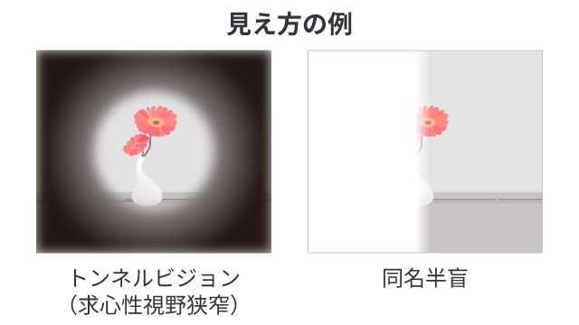 視野狭窄の見え方について説明する図です