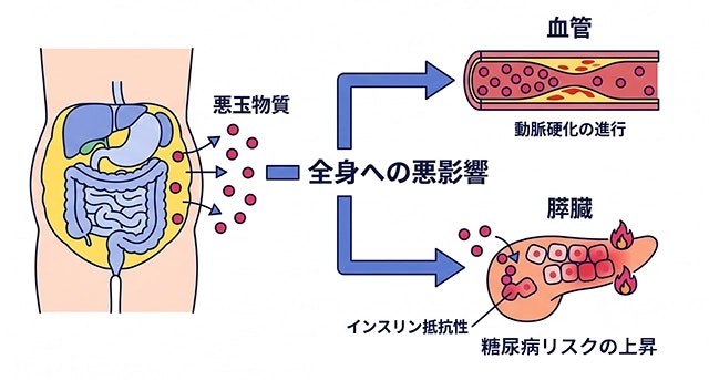 肥満症で、内臓脂肪から分泌される悪玉物質が、血管の動脈硬化や膵臓のインスリン抵抗性などを引き起こし、全身へ悪影響を及ぼすことを解説したイラストです。