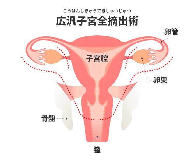 広汎子宮全摘出術のイラスト