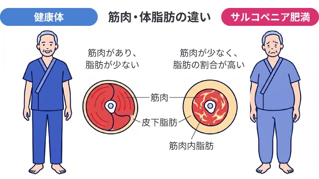 高齢者の肥満症で注意すべき「サルコペニア肥満」の特徴を、健康な状態と比較し、筋肉量が減少して皮下脂肪や筋肉内脂肪の割合が高くなっている足の断面図を用いて解説した図です。