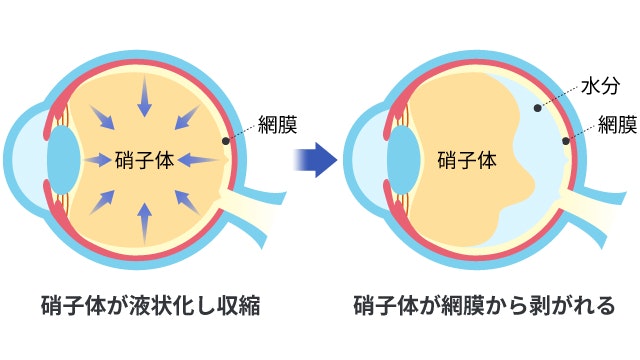 後部硝子体剥離を説明する図です