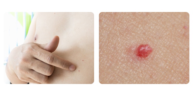 老人性血管腫について説明する図です