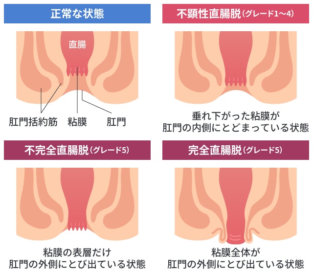 直腸脱がどんな状態か説明する図です