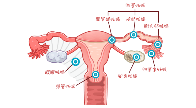 子宮外妊娠について説明している図になります。着床している部位によって、卵管妊娠、腹膜妊娠、頸管妊娠、卵巣妊娠と言われます。