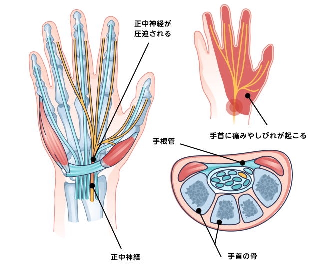 手根管症候群の図説