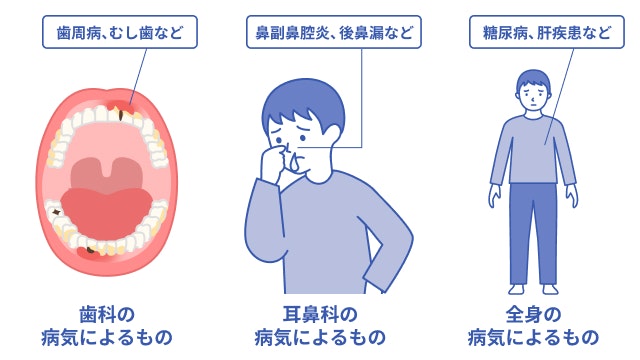 口臭の原因を説明する図です