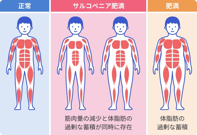 サルコペニア肥満を説明する図です