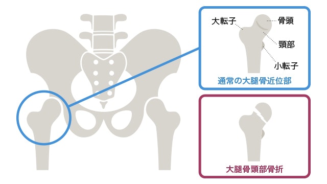 股関節骨折の説明