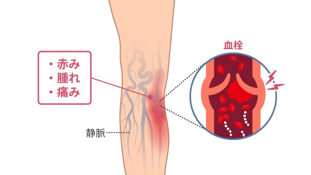 血栓性静脈炎を説明する図です