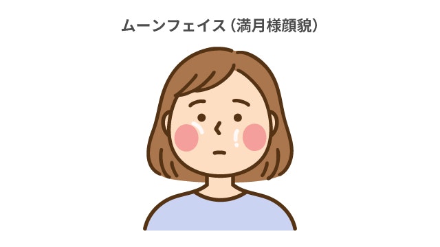 ムーンフェイスを説明する図です