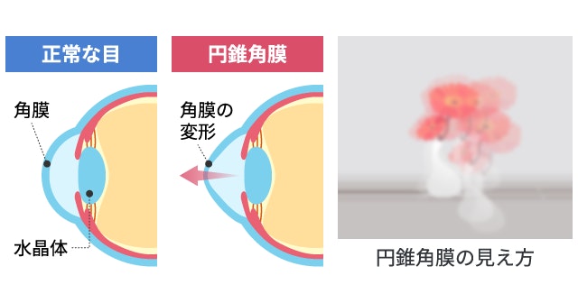 円錐角膜と正常な目の断面図比較および見え方のシミュレーション図解。角膜が前方へ円錐状に突出変形した状態と、それにより対象物がぼやけたり二重・三重に重なって見える（単眼複視）症状のイラスト。