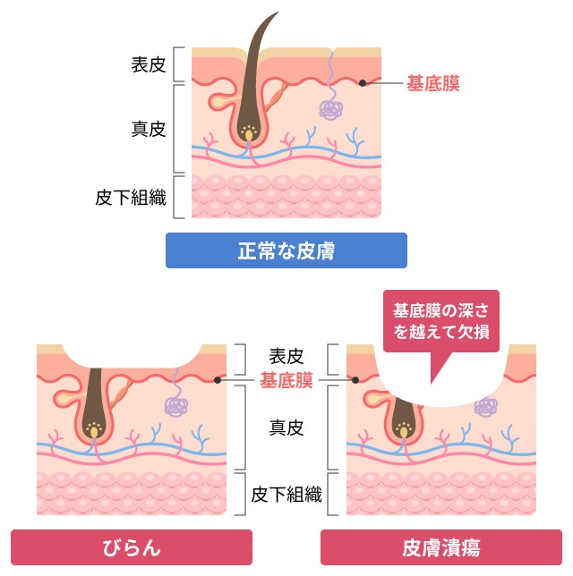 皮膚潰瘍を説明する図です