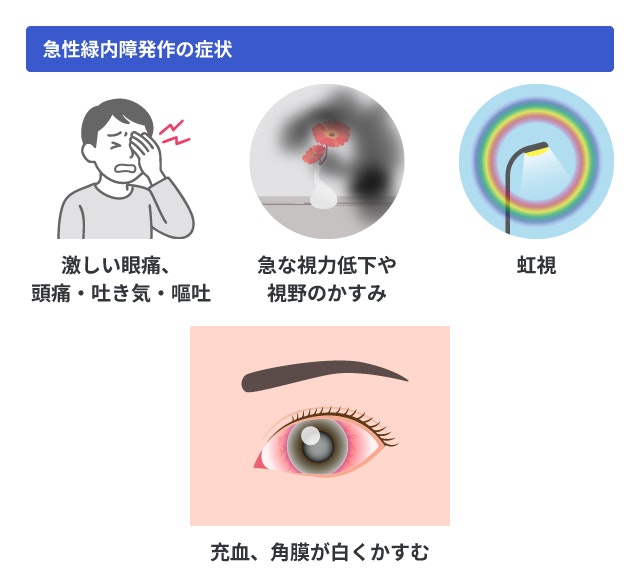急性緑内障発作の症状を説明する図です