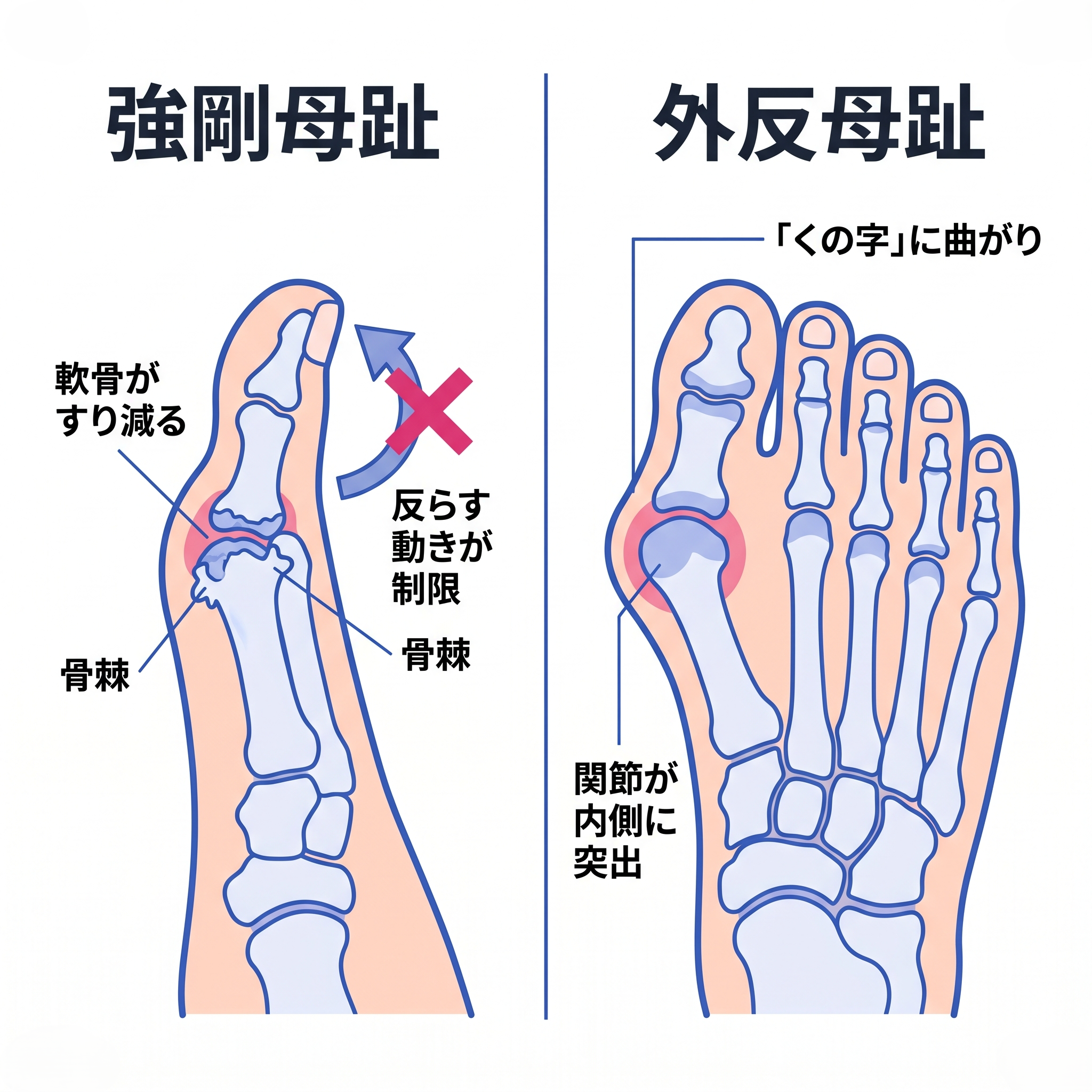強剛母趾（きょうごうぼし）と外反母趾（がいはんぼし）の違いを比較した足の骨格イラストです。左側は「強剛母趾」で、親指の付け根の関節の「軟骨がすり減る」状態や、「骨棘（こつきょく）」と呼ばれる骨のトゲができている状態が描かれています。また、親指を上へ「反らす動きが制限」されることが、バツ印のついた矢印で示されています。右側は「外反母趾」で、親指が人差し指側に「『くの字』に曲がり」、親指の付け根の「関節が内側に突出」している状態が赤い円で強調して描かれています。2つの疾患における関節の変形や症状の違いが対比して説明されています。