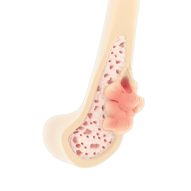 骨巨細胞腫」とはどのような病気ですか？ ｜骨巨細胞腫