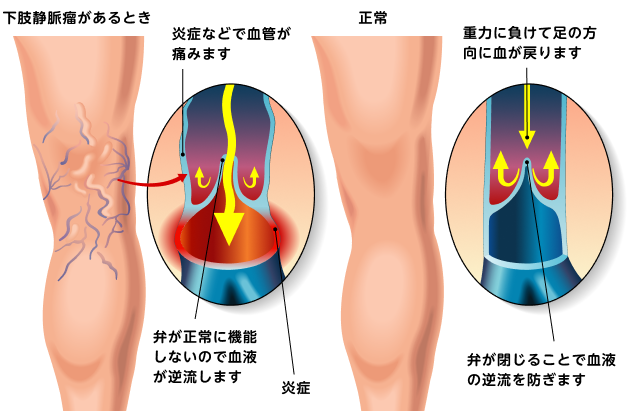 正常な血管と下肢静脈瘤の人の血管の違いを示す図
