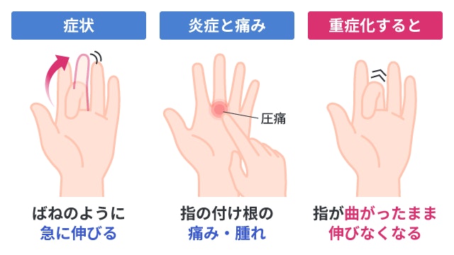 ばね指の代表的な症状と進行を示すイラスト。指が急に伸びるばね現象、指の付け根の圧痛や腫れ、重症化して指が曲がったまま伸びなくなる状態を視覚的に説明しています。
