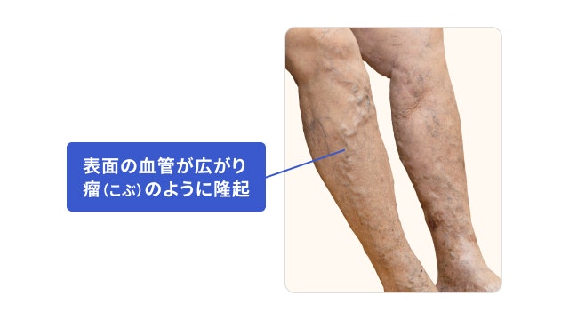 足の血管が浮き出る状態を説明する図です