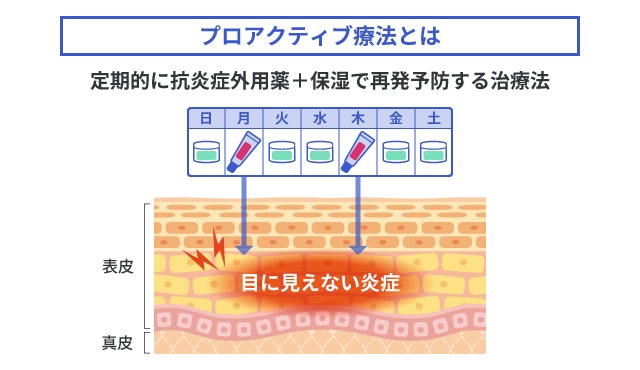 小児アトピー性皮膚炎の再発を防ぐプロアクティブ療法として、皮膚の奥に残る「目に見えない炎症」へ定期的に薬や保湿剤を塗る仕組みを、カレンダーと皮膚断面図を用いて分かりやすく解説したイラスト。
