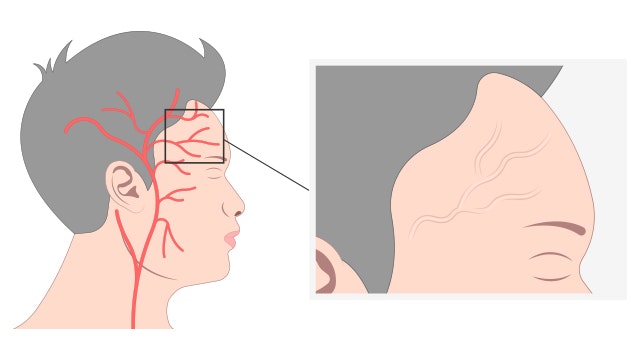 巨細胞性動脈炎を治療する他の薬はありますか?