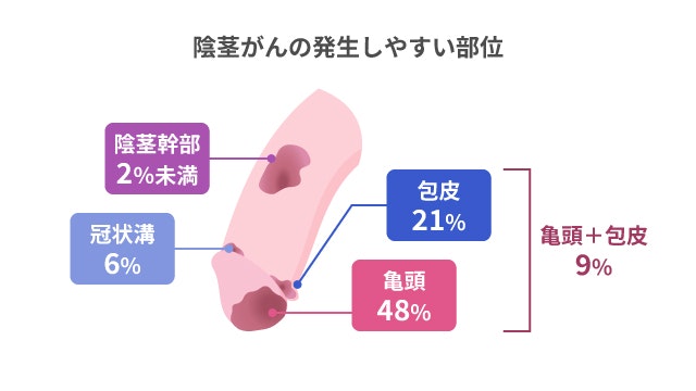 陰茎がんの発生しやすい部位を説明する図です