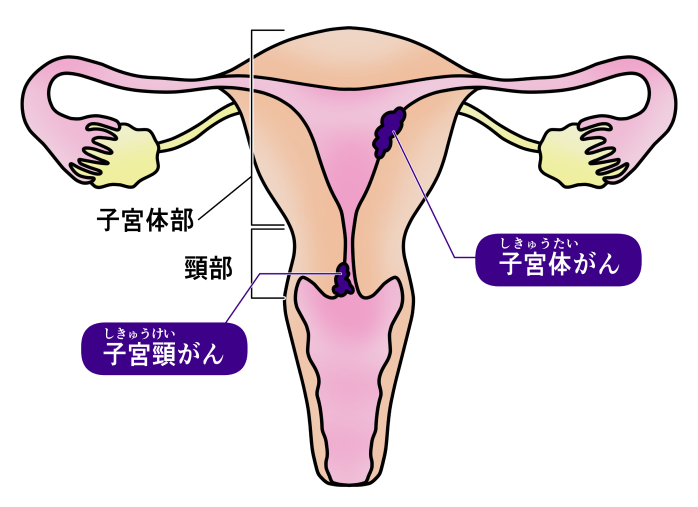子宮体がんの説明