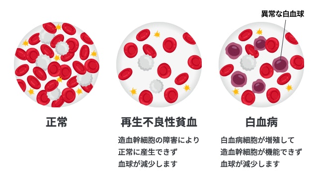 正常な血液、再生不良性貧血、白血病の血球状態の違いを示す比較図。再生不良性貧血は「造血幹細胞の障害により赤血球・白血球・血小板すべてが減少（スカスカの状態）」しているのに対し、白血病は「異常な白血球が増殖し、正常な血球が作れなくなる」というメカニズムの違いを図解。