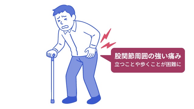 大腿骨頸部骨折での股関節周囲の痛みを説明する図です