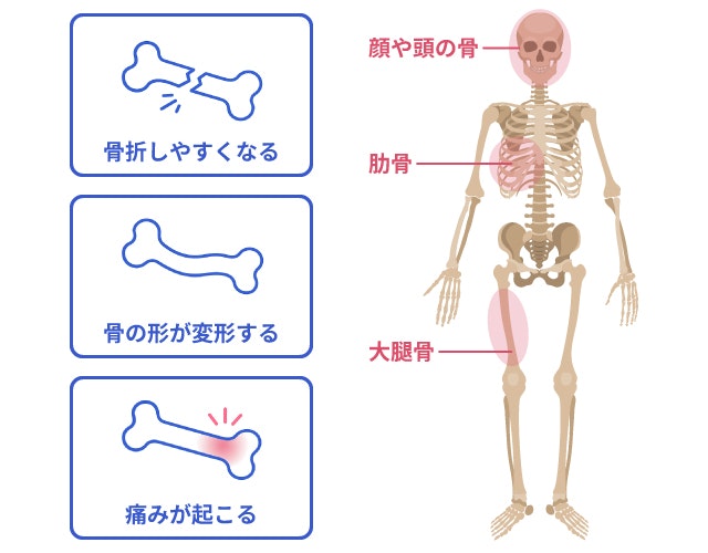 線維性骨異形成症を説明する図です