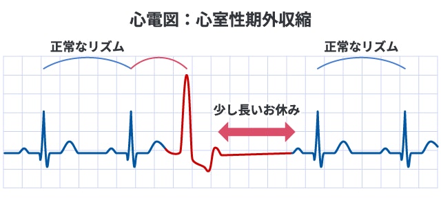 心室性期外収縮の心電図波形の模式図。正常なリズムの中に、幅が広く大きな異常波形が通常より早いタイミングで出現し、その直後に少し長い休止期を挟んで再び正常な拍動に戻る様子を描写しています。