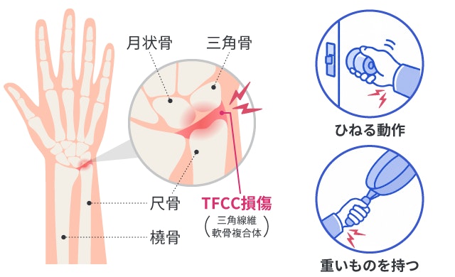 TFCC損傷（三角線維軟骨複合体損傷）が起きる部位と、痛みの原因となる動作を解説したイラストです。手首の小指側、尺骨と手根骨（月状骨・三角骨）の間にあるTFCCが赤く損傷している解剖図を示しています。また、ドアノブを回すような手首をひねる動作や、フライパンなどの重いものを持つ動作によって、手首に痛みが走る状態を具体的に描写しています。