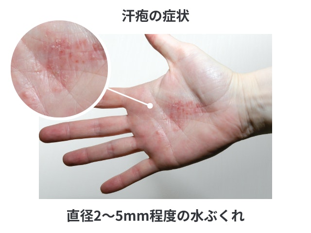 汗疱が手のひらに発生している症状の写真です。手のひらの中央部分に、赤みを帯びた直径2〜5ミリメートル程度のブツブツとした半透明の水ぶくれが多数密集して広がっている様子が写されています。