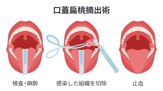 口蓋扁桃摘出術を説明する図です