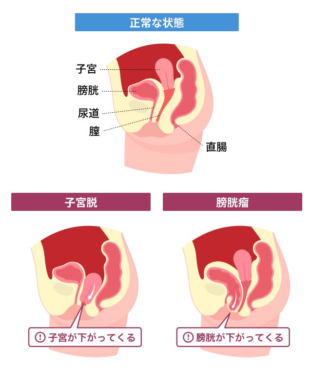 子宮脱、膀胱瘤のイラスト