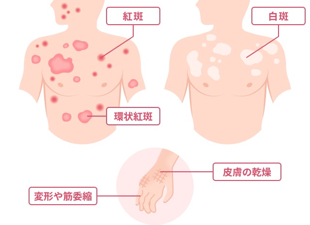 ハンセン病を説明する図です