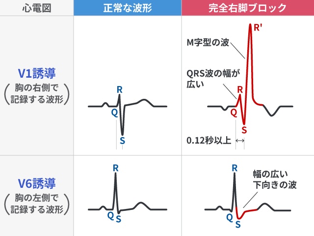 完全右脚ブロックの心電図において、V1誘導でM字型かつ0.12秒以上の広いQRS波となり、V6誘導で幅の広い下向きの波となる特徴的な変化を、正常な波形と比較した図です。