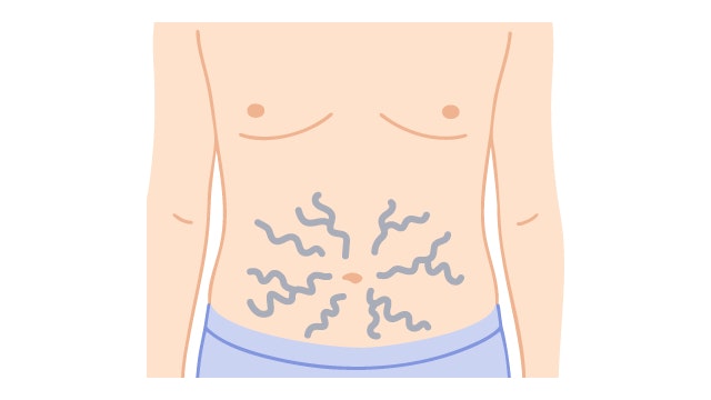 肝硬変の（メデューサの頭のような）症状について説明する図です