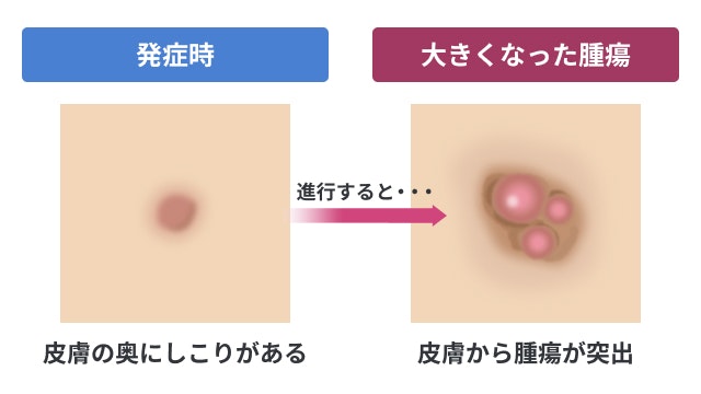 隆起性皮膚線維肉腫（DFSP）が進行したときの状態を説明した図です