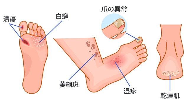 糖尿病の皮膚障害を説明する図です