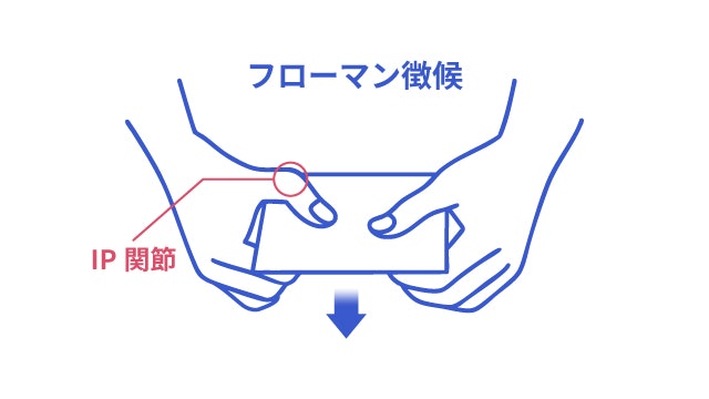 フローマン徴候を説明する図です