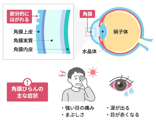 角膜びらんの症状と原因の図解。角膜表面の上皮が部分的に剥がれている断面図と、それに伴う強い目の痛み・まぶしさ・涙が出る・目が赤くなる(充血)のイラスト。