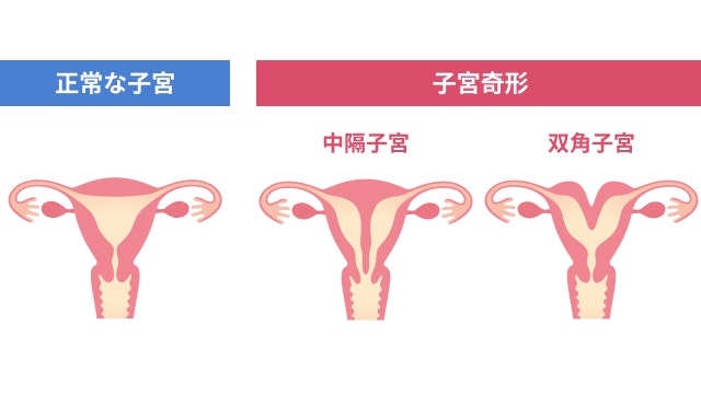子宮発育不全における子宮の形状を説明しています。