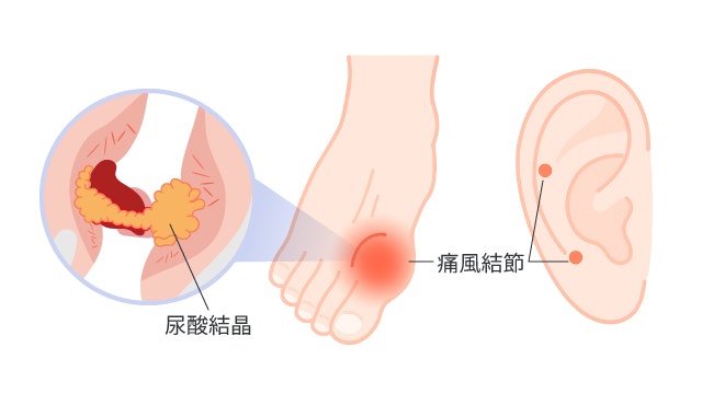 痛風結節について説明する図です。