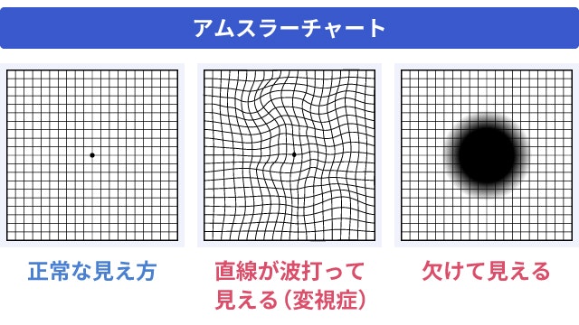 黄斑前膜のセルフチェックについて説明する図です