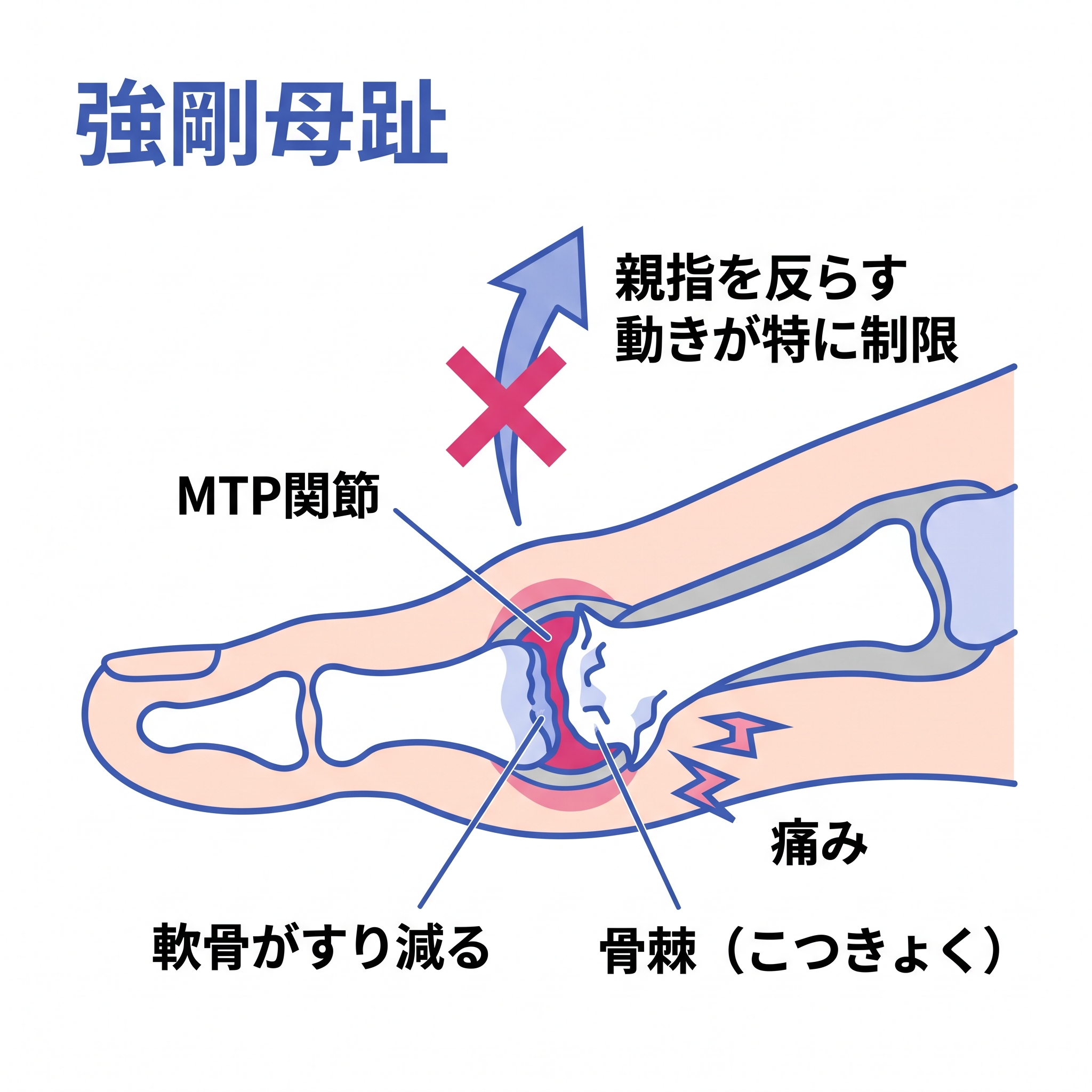 強剛母趾（きょうごうぼし）が起きている足の内部の様子を説明した断面図のイラストです。足の親指の付け根にある「MTP関節」を中心に描かれており、関節部分の「軟骨がすり減る」状態と、骨の縁に「骨棘（こつきょく）」と呼ばれるトゲのような変形が生じている状態が示されています。さらに関節の下側には「痛み」が発生していることを表すマークがあり、上側にはバツ印のついた矢印とともに「親指を反らす動きが特に制限」されるという症状の特徴が記載されています。