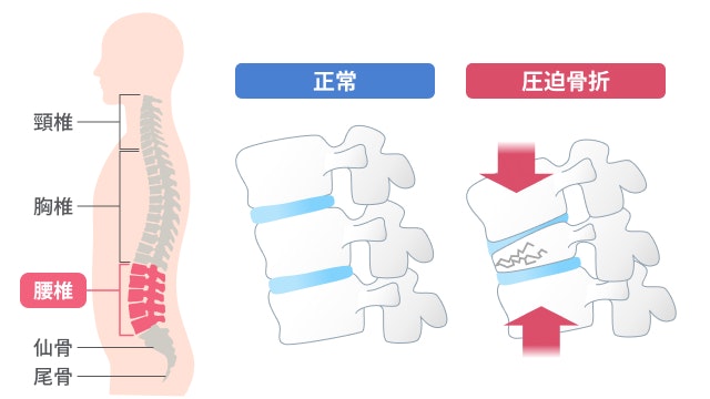 腰椎圧迫骨折を説明する図です