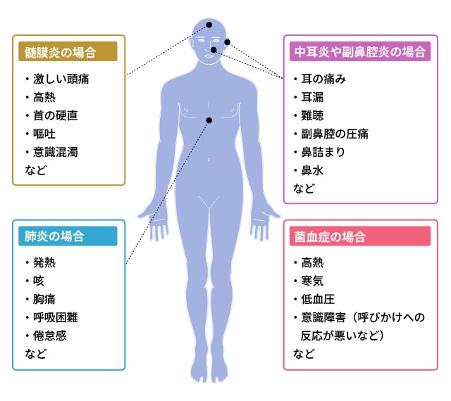 肺炎球菌感染症の症状のイラスト