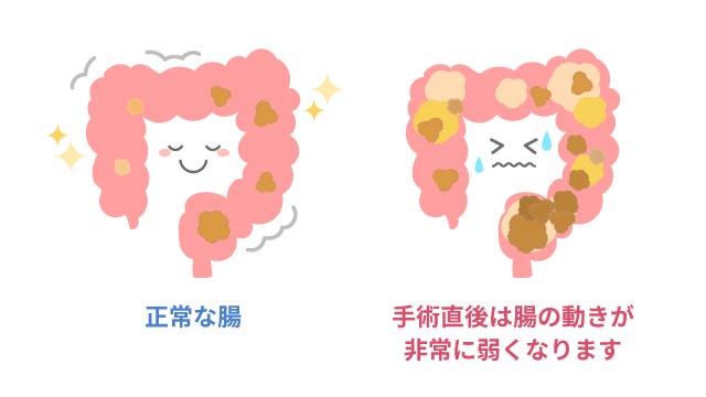 術後イレウスを説明する図です