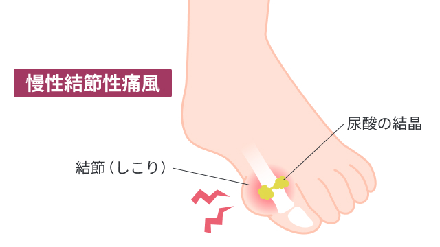 慢性結節性痛風を説明する図です